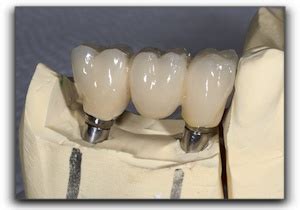 crown metal fabrications ltd|procedure for a dental crown.